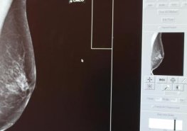 Poznejte svá prsa a nepodceňujte prevenci. Růžový říjen připomíná boj proti rakovině prsu