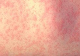 Interna ve Svitavské nemocnici dočasně upravila provoz kvůli spalničkám