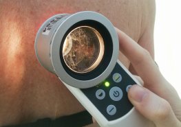 Jak poznat zdravé mateřské znaménko od „podezřelého“?