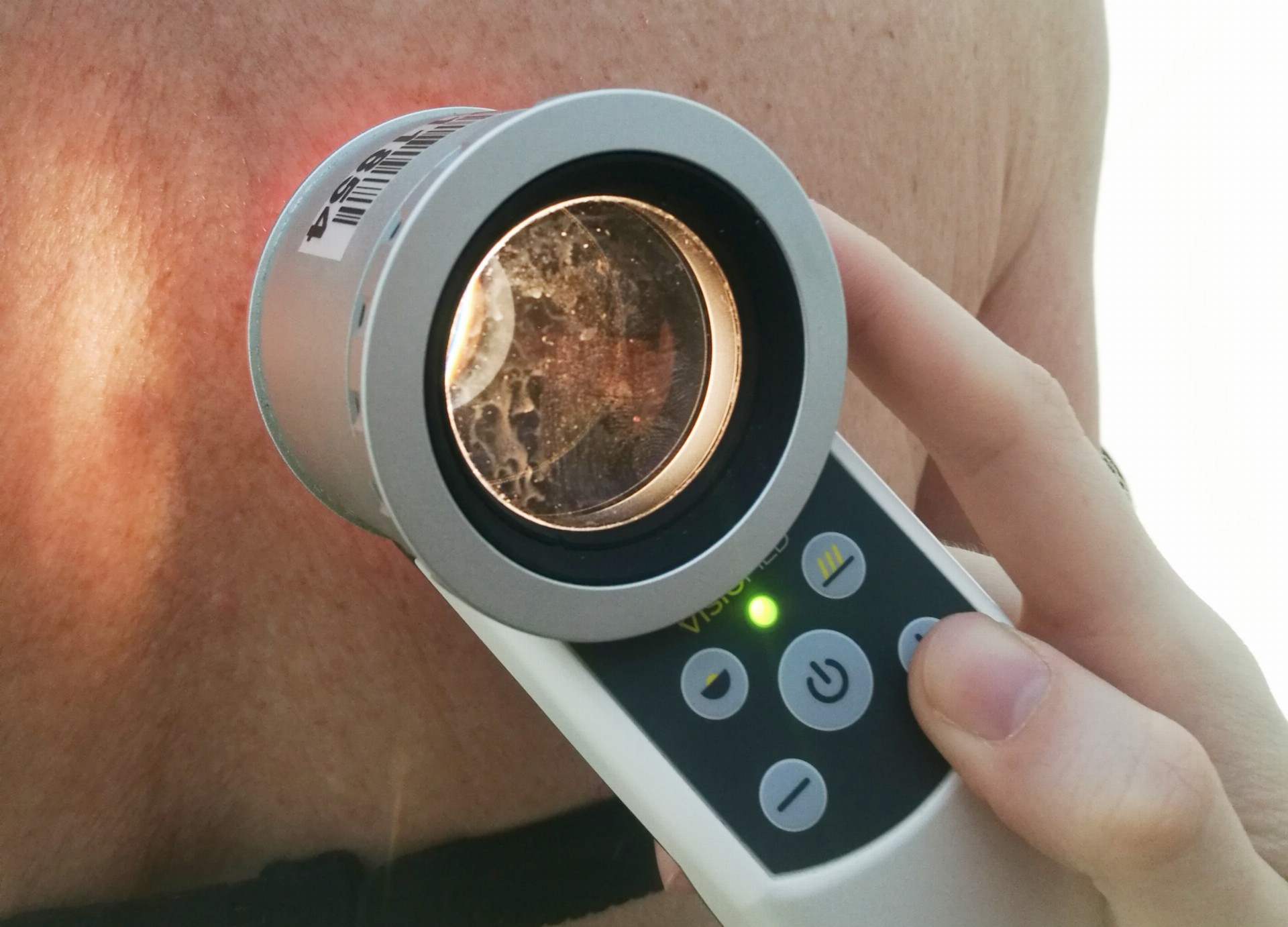 Jak poznat zdravé mateřské znaménko od „podezřelého“?